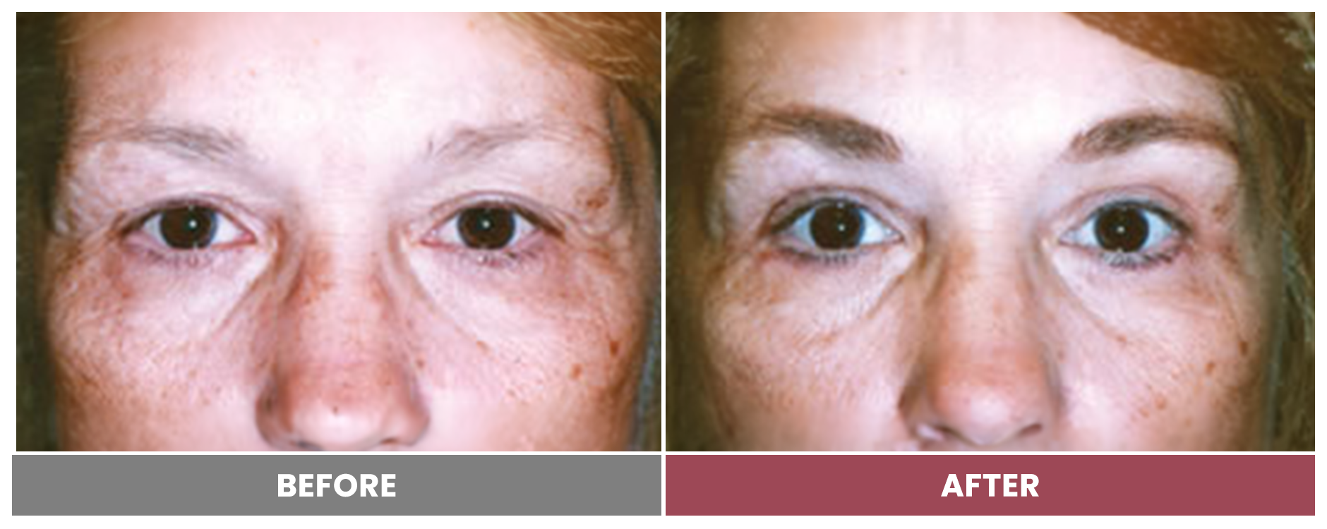 Upper Blepharoplasty - Case 65